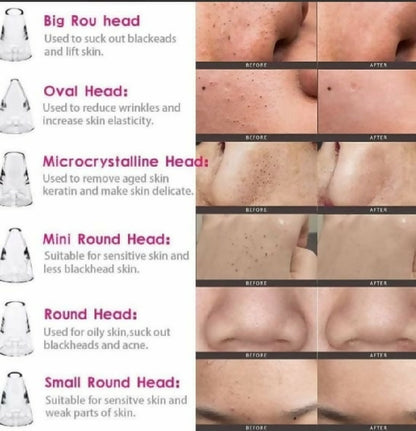 Electric Blackhead Remover Vacuum Pore Cleaner